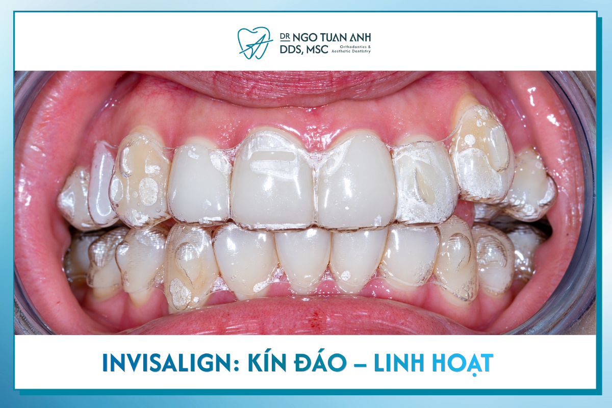 Invisalign