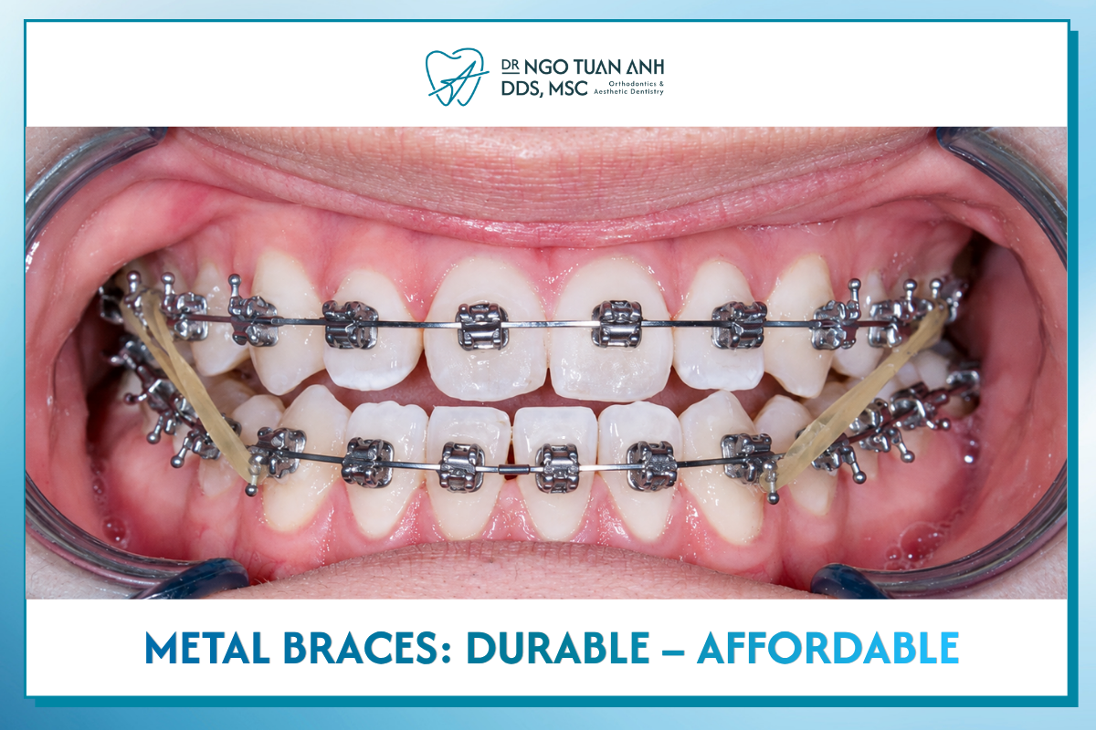 Metal braces 